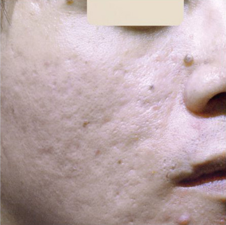 trattamento macchie acne